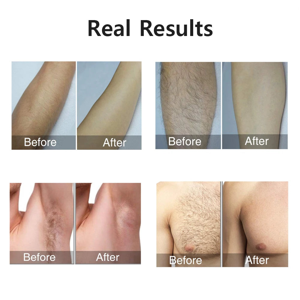 Portable IPL Laser Epilator 999999 Flashes - Painless, Permanent Hair