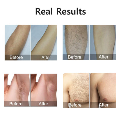 Portable IPL Laser Epilator 999999 Flashes - Painless, Permanent Hair
